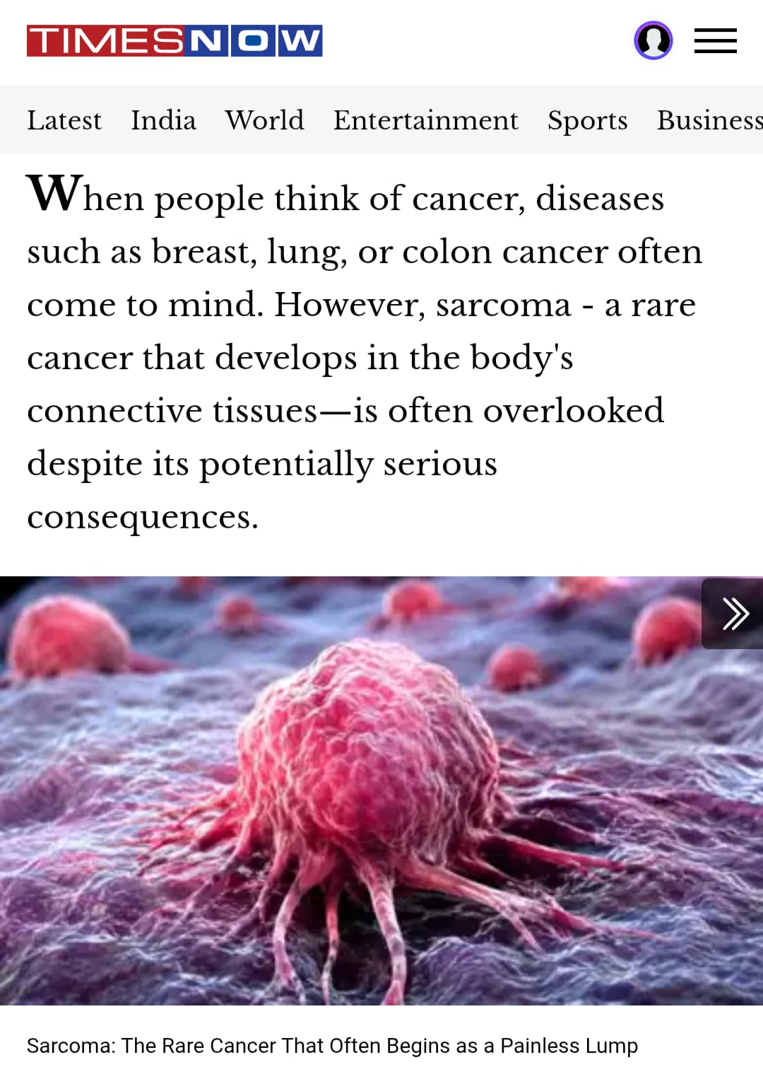 Sarcoma Explained: The Rare Cancer That Often Starts as a Painless Lump